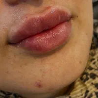 ژل و بوتاکس ‌‌پاکسازی|خدمات آرایشگری و زیبایی|مشهد, شهید معقول|دیوار