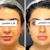 جوانسازی و لیفت پوست بدون جراحی با قویترین هایفو|خدمات آرایشگری و زیبایی|کرج, فاز ۲ مهرشهر|دیوار