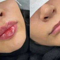 ژل و بوتاکس در دزفول