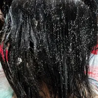 پاکسازی تک جلسه ای شپش ورشک سر در مکانی خصوصی