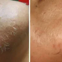برداشت موهای زائد به روش الکترولیز صد درصد تضمینی