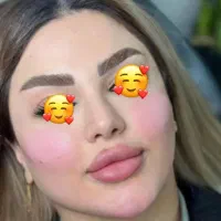 ژل و بوتاکس|خدمات آرایشگری و زیبایی|کارون, |دیوار