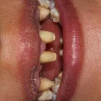 وام دندانپزشکی عصبکشی ایمپلنت .کامپوزیت|خدمات آرایشگری و زیبایی|تبریز, |دیوار