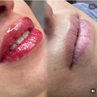 شیدینگ لب با هزینه استثنایی (برای مدتی محدود)