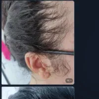 درمان ریزش رویش مو و ریش