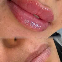 مرکز لیزر و زیبایی الماس.اندولیفت.بوتاکس.ژل لاغری|خدمات آرایشگری و زیبایی|اصفهان, شاهزید|دیوار
