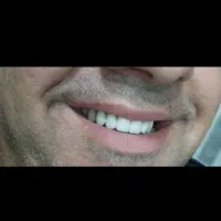 دندانسازی  دندان مصنوعی  پروتز دندان|خدمات آرایشگری و زیبایی|قم, کلهری|دیوار