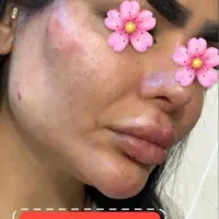 خدمات ژل وبوتاکس و پروتئن