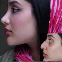عمل جراحی بینی /ترمیم/مشاوره رایگان/لیپو ابدو