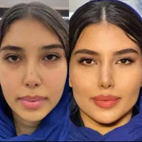 ژل لب،گونه،چانه،زاویه،شقیقه تخفیف عیدانه