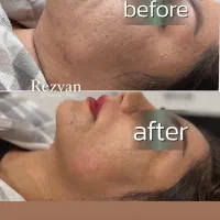 هایفو تراپی ۱۲ بعدی کره ای در مطب پزشک بدون درد