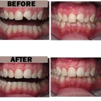 خدمات دندانپزشکی تاکستان ( آفر ویژه )