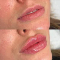 مدل تزریق فیلر  فقط یک عدد
