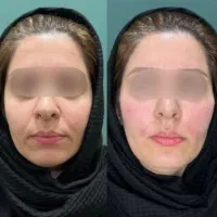 هایفوتراپی در مطب پزشک با قیمتی باورنکردنی|خدمات آرایشگری و زیبایی|مشهد, چهارچشمه|دیوار