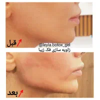 آموزش وارائه خدمات ژل و بوتاکس و فیلربادی(ژل بدن)|خدمات آرایشگری و زیبایی|جهرم, |دیوار