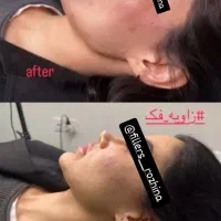 تزریق ژل بوتاکس صورت فرصت محدود