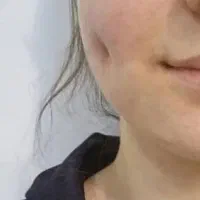 پیرسینگ و چالگونه