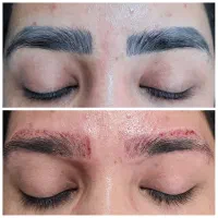 پاک کردن تتو، لیزر مو زائد، بلفاروپلاستی در شهرری