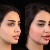 سریعترین تغییر باکمترین هزینه،فیلربوتاکس نخ ژل مزو