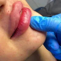 تزریق فیلر