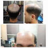 پروتز مو وارداتی درجه یک