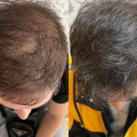 آموزش و خدمات میکرواسکالپ مکمل کاشت مو|خدمات آرایشگری و زیبایی|رشت, بوسار|دیوار