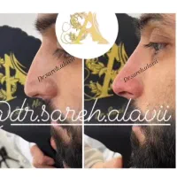 اصلاح فرم و کوچک کردن بینی توسط پزشک بدون جراحی|خدمات آرایشگری و زیبایی|قم, دورشهر|دیوار