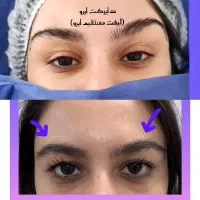 تخلیه وتزریق چربی لابیا جراحی پلک دایرکت اتوپلاستی