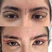 بلفاروپلاستی لیزری فقط 9.900