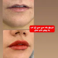 تزریقات. و جوانسازی پوست با فیلر و بوتاکس|آرایشی، بهداشتی، درمانی|اهواز, زیتون کارگری|دیوار