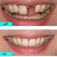 دندانپزشک اقساط کامپوزیت لمینیت لب شیشه ای بلیچینگ|خدمات آرایشگری و زیبایی|مشهد, سجاد شهر|دیوار