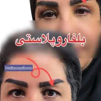 بلفاروپلاستی کاشت ابرو کاشت مو تخفیف|خدمات آرایشگری و زیبایی|تهران, دریاچه شهدای خلیج فارس|دیوار