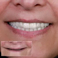 ایمپلنت دیجیتال اقساطی بدون سود در انواع برندها