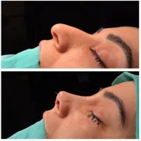 عمل بینی|خدمات آرایشگری و زیبایی|کرج, عظیمیه|دیوار