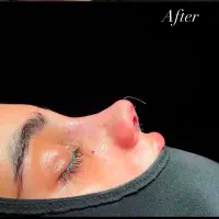 جراحی بینی اقساطی کلینیک مهرزاد -تخفیف ۱۰ میلیونی