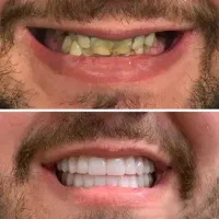 دندان پزشکی ایمپلنت کره ای فقط 10میلیون با ضمانت