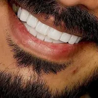 کامپوزیت دندان لمینت دندان با ضمانت|خدمات آرایشگری و زیبایی|کرج, گوهردشت|دیوار