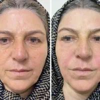 جشنواره تخفیف پلاژن، هایفو،کرایو،ام اسکالپ|خدمات آرایشگری و زیبایی|شیراز, فرهنگ شهر|دیوار
