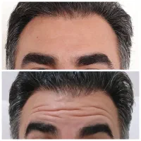 بوتاکس|خدمات آرایشگری و زیبایی|سنقر, |دیوار