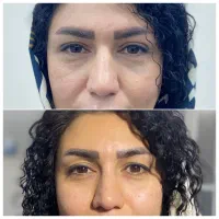 جراحی پلک با بخیه لیزری توسط جراح متخصص زیبایی|خدمات آرایشگری و زیبایی|تهران, تجریش|دیوار