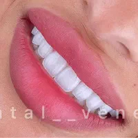 دندانپزشکی لمینت الهیه منطقه ۱ کامپوزیت سرامیکی|خدمات آرایشگری و زیبایی|تهران, الهیه|دیوار