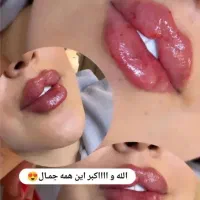 ژل لب ۶۵۰بوتاکس ۶۰۰مصبورت توسط پزشک متخصص