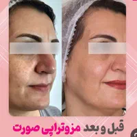 جشنواره *هفت روزه*تزریق ژل و بوتاکس،فیلر،مزوتراپی|خدمات آرایشگری و زیبایی|یاسوج, |دیوار