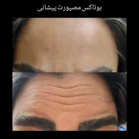 تزریق ژل وبوتاکس