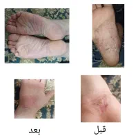 اگه ازترک پوستی رنج میبری پیام بده