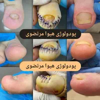 درمان بیماری ناخن و ارتونیل (پودولوژی)|خدمات آرایشگری و زیبایی|اصفهان, سعادت‌آباد|دیوار