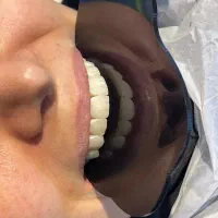 کامپوزیت دندان زیبایی. روکش. دندان مصنوعی .ترمیم