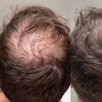 چطورموهای‌کم پشت شده‌رواحیاوپرپشت‌کنیم‌