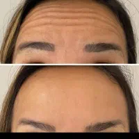 تزریق بوتاکس وژل فقط قیمت مواد