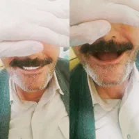 دندانسازی روکش  کامپوزیت  عصب کشی دندان مصنوعی